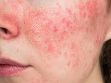Skin Infection